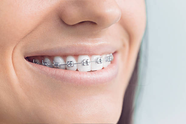 Dental Bonding in East Syracuse, NY
